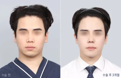 Before & After