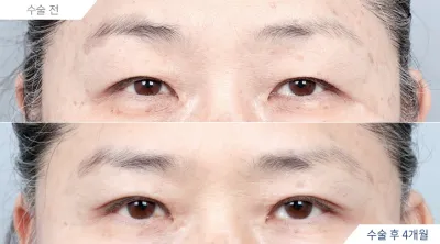 Before & After