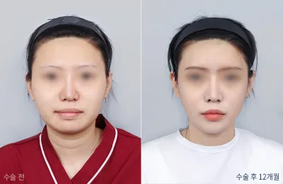 Before & After