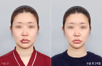 Before & After