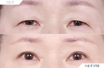 Before & After