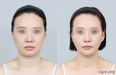 Before & After
