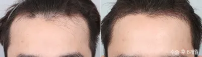 Before & After