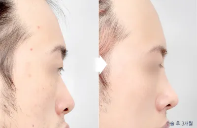 Before & After