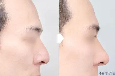 Before & After