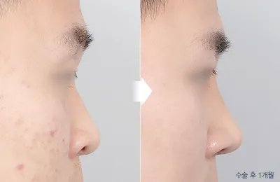 Before & After