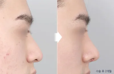 Before & After