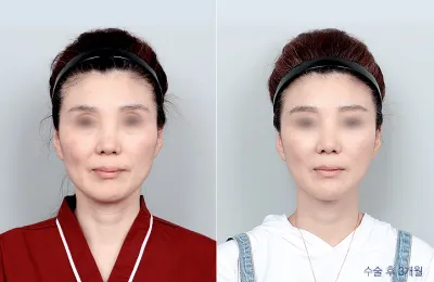 Before & After