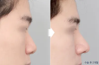 Before & After
