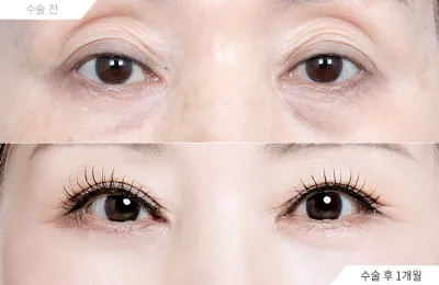 Before & After