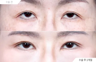 Before & After