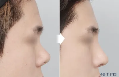 Before & After