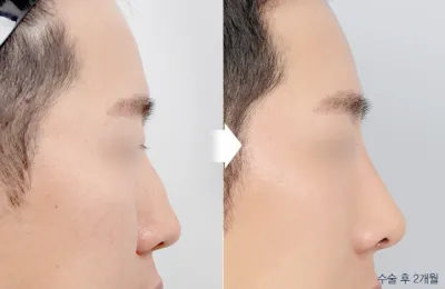 Before & After