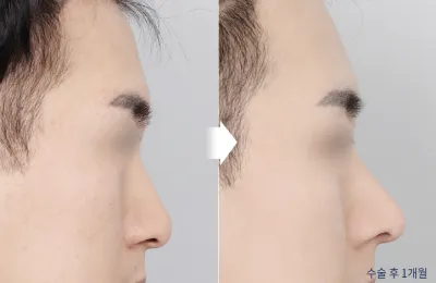 Before & After