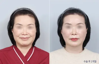 Before & After