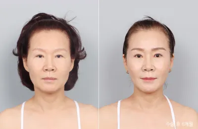 Before & After