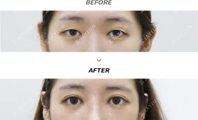 Before & After