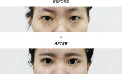 Before & After
