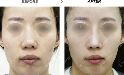 Before & After