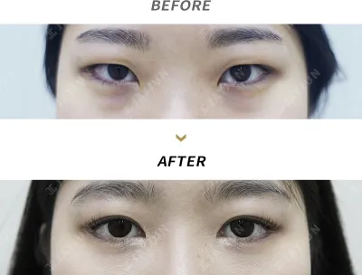 Before & After