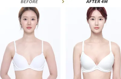 Before & After