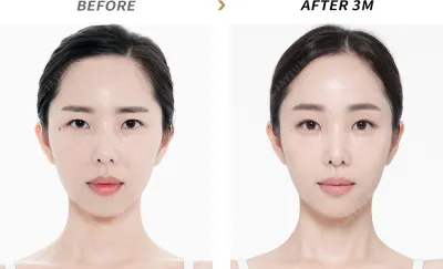 Before & After
