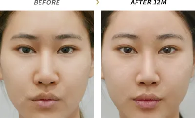 Before & After