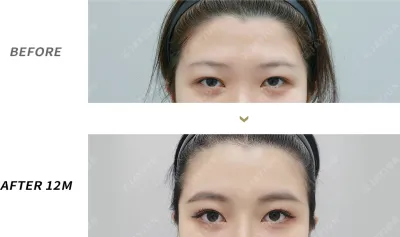 Before & After