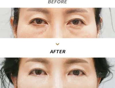 Before & After