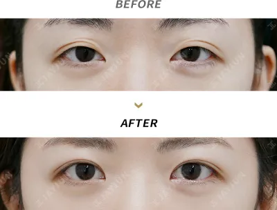 Before & After
