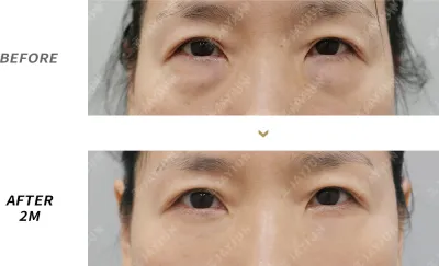 Before & After