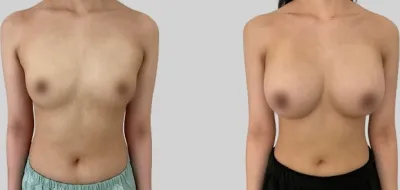 Before & After