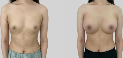 Before & After