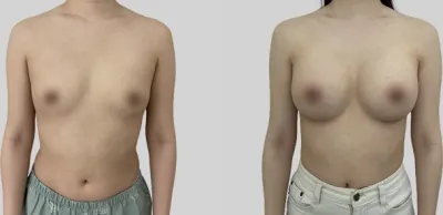 Before & After