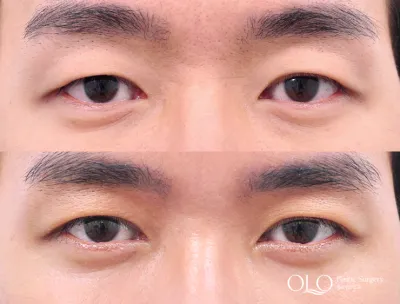 Before & After