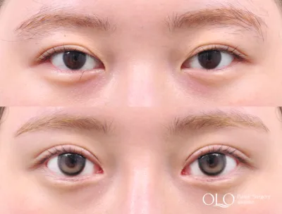 Before & After