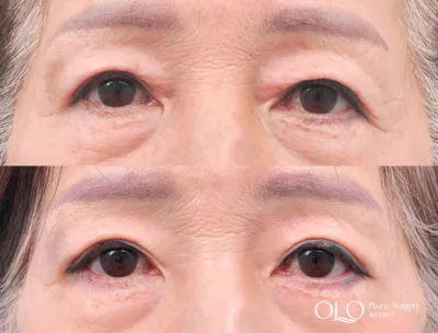 Before & After