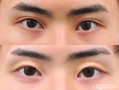 Before & After