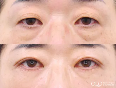 Before & After