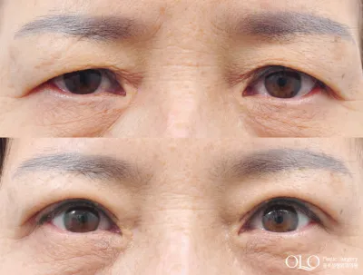 Before & After