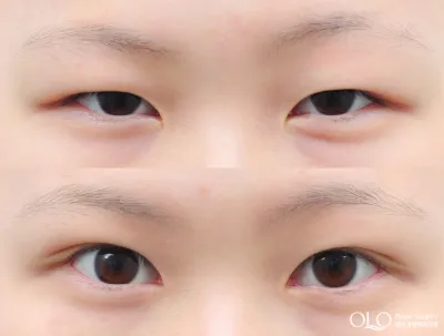 Before & After