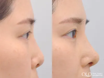 Before & After