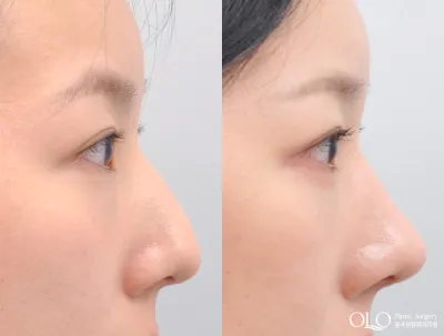 Before & After