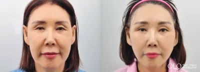 Before & After