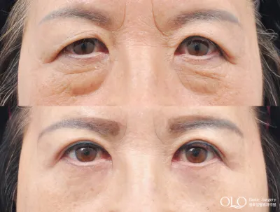 Before & After
