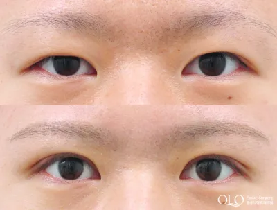 Before & After