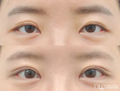 Before & After