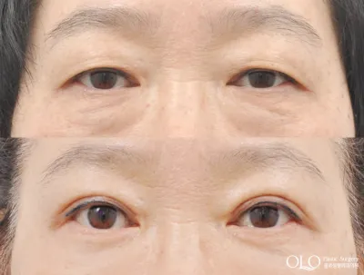 Before & After
