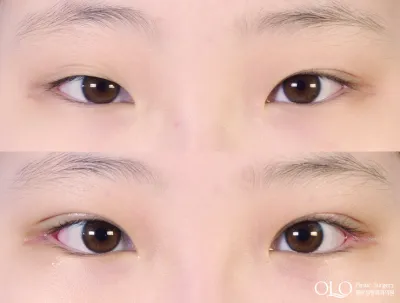 Before & After