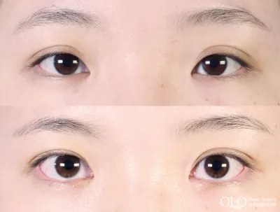 Before & After